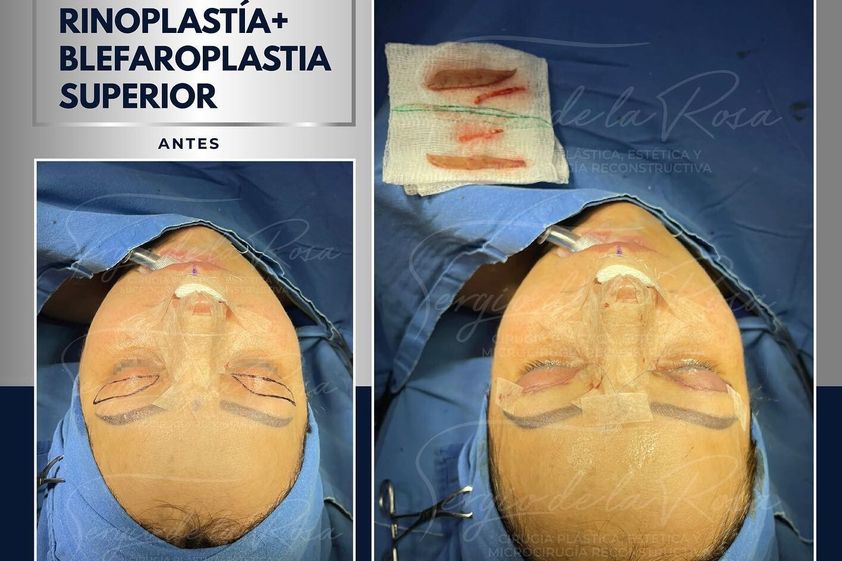 Blefaroplastia antes y después - 840031