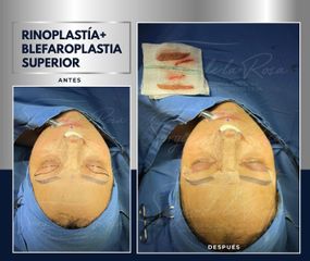 Blefaroplastia - Dr. Sergio de la Rosa Serrano