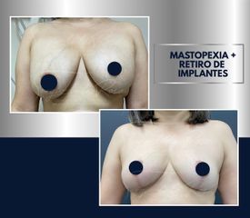 Mastopexia - Dr. Sergio de la Rosa Serrano