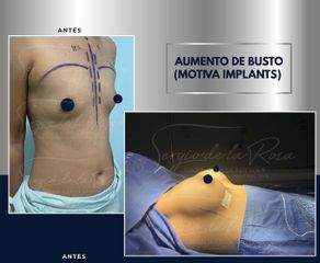 Aumento de busto - Dr. Sergio de la Rosa Serrano