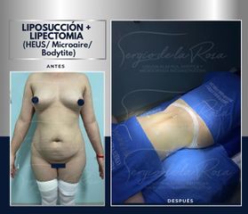 Abdominoplastia - Dr. Sergio de la Rosa Serrano