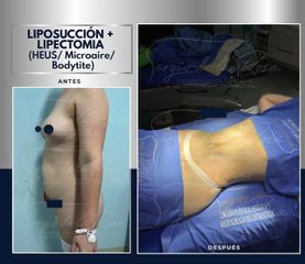 Abdominoplastia - Dr. Sergio de la Rosa Serrano