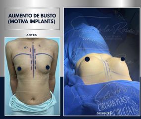 Aumento de busto - Dr. Sergio de la Rosa Serrano