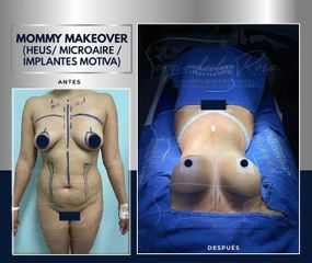 Mommy Makeover - Dr. Sergio de la Rosa Serrano