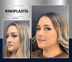 Rinoplastia - Dr. Sergio de la Rosa Serrano