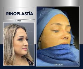 Rinoplastia - Dr. Sergio de la Rosa Serrano