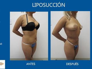 Antes y después de liposucción
