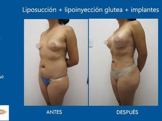 Antes y después de liposucción