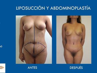 Antes y después de liposucción y abdominoplastia