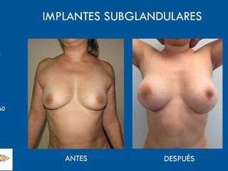 Antes y después de implantes subglandulares