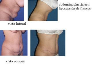 Antes y después de una abdominoplastia y liposucción de flancos