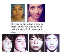 Antes y después de un procedimiento de Bolsas de Bichat