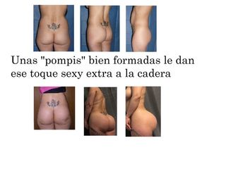 Antes y después de una gluteoplastia