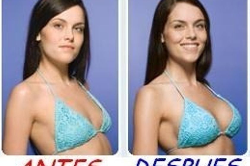 Aumento de busto antes y después - 325748