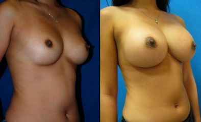 Antes y después de Aumento de busto