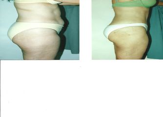 Antes y después de Abdominoplastía