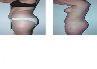 Antes y después de Abdominoplastía