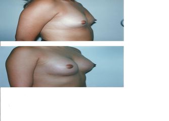 Antes y después de Aumento de busto