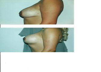 Antes y después de Aumento de busto