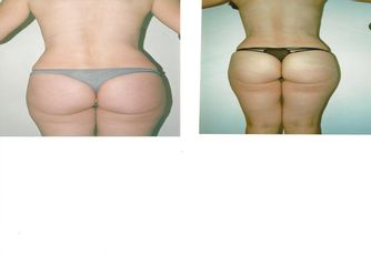 Antes y después de Lipoescultura