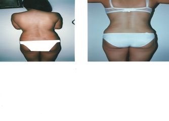 Antes y después de Lipoescultura