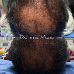 Alopecia - Dra. Ionica Mihaela Dogaru