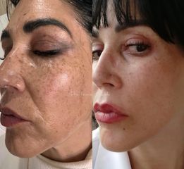 Eliminación de melasma - Dra. Ionica Mihaela Dogaru