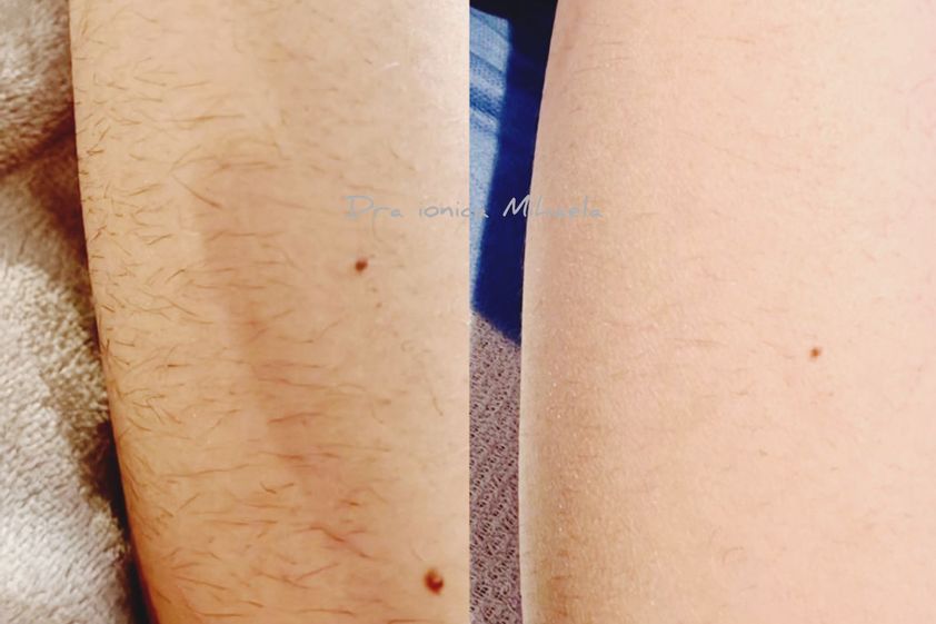 Depilación láser antes y después - 847955