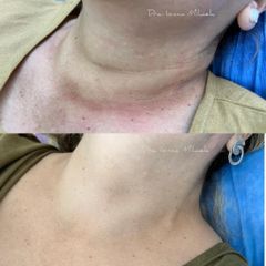 Laser co2 en cuello - Dra. Ionica Mihaela Dogaru