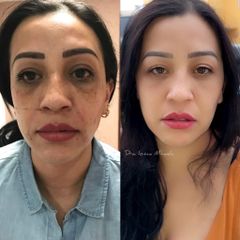 Rejuvenecimiento facial - Dra. Ionica Mihaela Dogaru