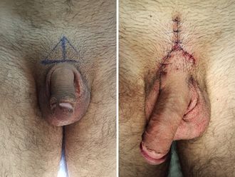 Alargamiento de pene antes y después - 662802