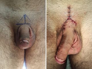 Alargamiento de pene - Dr. Saulo Camarena