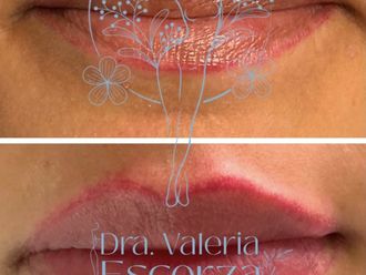 Aumento de labios antes y después - 875784