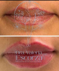 Aumento de Labios - Dra. Valeria Escorza Rodriguez