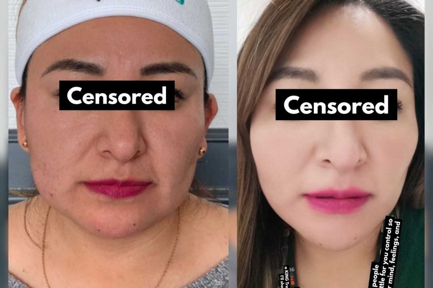Lipólisis antes y después - 808110