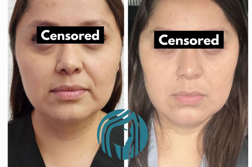 Tratamientos faciales antes y después - 863964