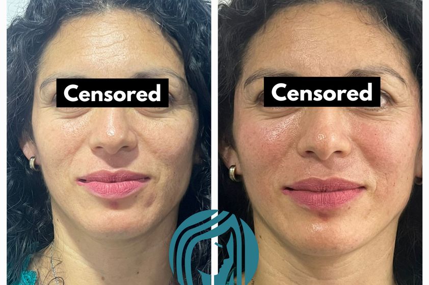 Tratamientos faciales antes y después - 868153