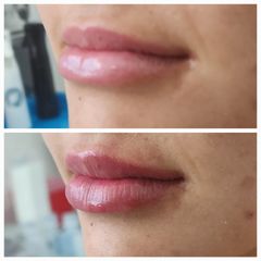Aumento de labios - Dr. Francisco Hernández