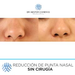Antes y después de Reducción de punta nasal sin cirugía 
