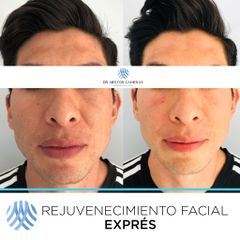 Antes y después de Rejuvenecimiento facial