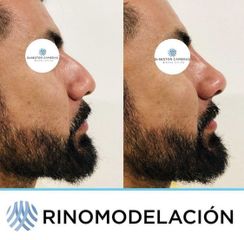 Antes y después de Rinomodelación