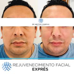 Antes y después de Rejuvenecimiento facial