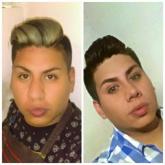 Rinoplastia - Dr. Luis Alfredo Romero