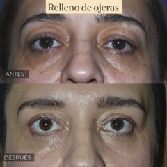 Antes y después de Relleno de ojeras - Ácido Hialurónico 