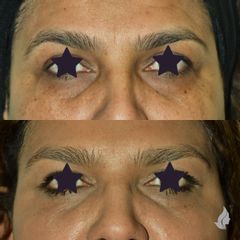 Antes y después de Relleno de ojeras - Ácido Hialurónico 