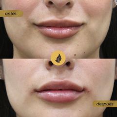 Antes y después de Relleno labios 