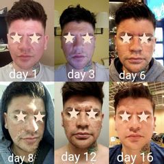 Antes y después de Peeling 