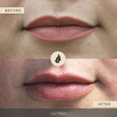 Antes y después de Aumento de labios -