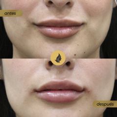 Aumento de labios - Imagen Art Clinic