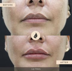 Aumento de labios - Imagen Art Clinic